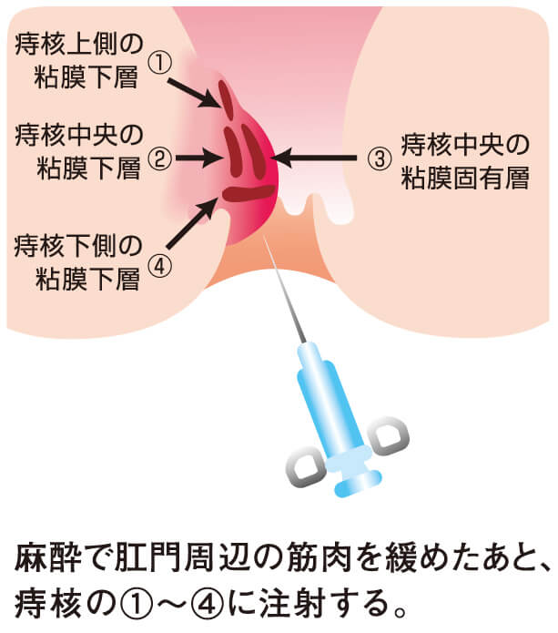 ジオン注射療法