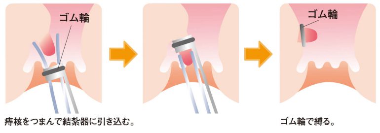 ゴム結紮療法
