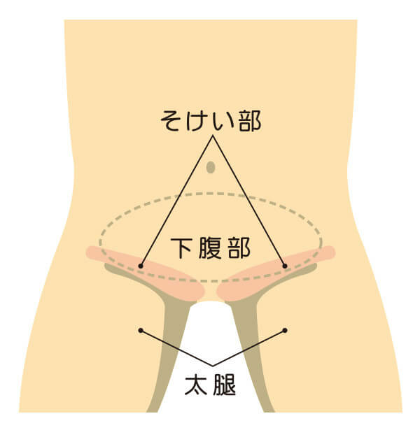 鼠径ヘルニアの治療について